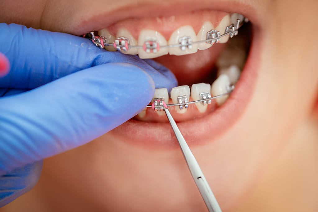 A close-up of a person’s mouth with metal braces while a gloved hand adjusts the brackets using a dental tool, highlighting adult orthodontics in Pflugerville to help straighten teeth.