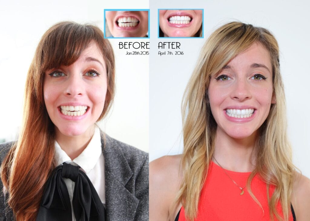 Side-by-side photos of a woman before and after dental treatment, showing noticeable teeth alignment improvement; dates shown are January 28, 2015 and April 7, 2016.