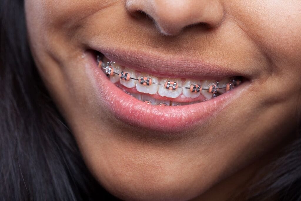 Close-up of a person smiling, showing metal braces on their teeth.